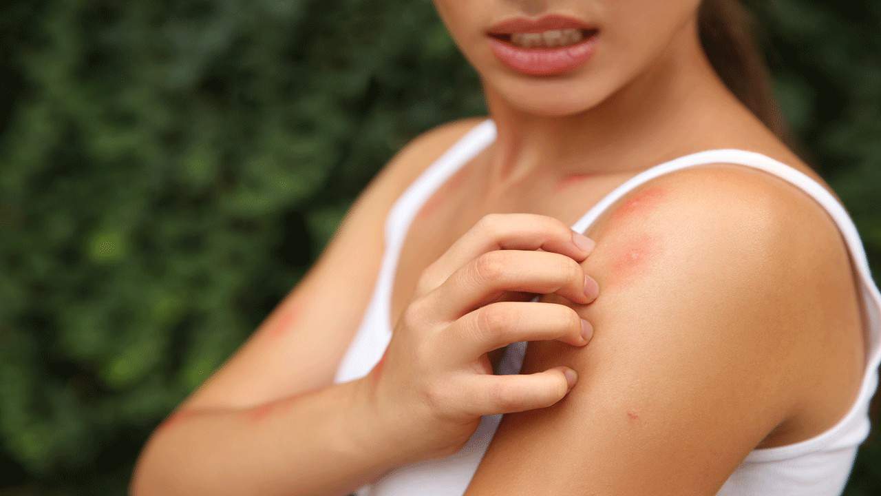 woman-with-bug-bite